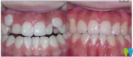 王涪華醫(yī)生成人虎牙矯正前后對(duì)比案例圖 王涪華醫(yī)生成人虎牙矯正前后對(duì)比案例圖