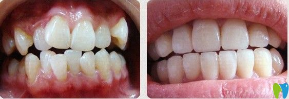 王涪華院長(zhǎng)青少年牙齒擁擠矯正前后對(duì)比照 王涪華院長(zhǎng)青少年牙齒擁擠矯正前后對(duì)比照