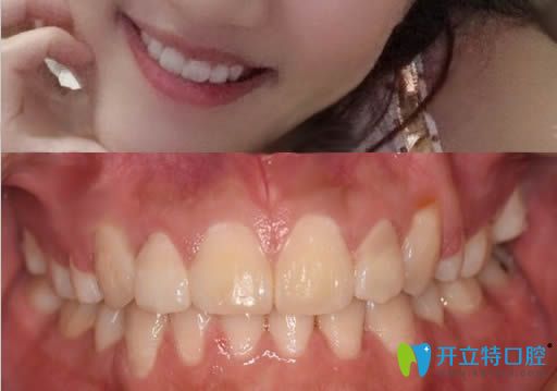 洛陽(yáng)九龍口腔牙齒矯正和美白術(shù)后照