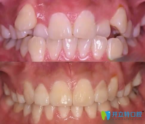 連江縣江南胡明輝口腔牙齒矯正案例效果圖