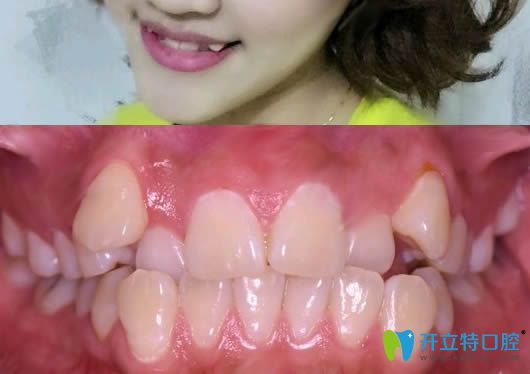 覺得洛陽九龍口腔的收費不貴,于是做了牙齒矯正和美白