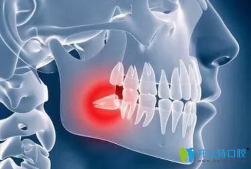 求解：我拔一顆智齒花了500多塊錢(qián)是不是被坑了？