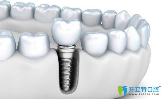 劉安賞告訴大家：種植牙的價格主要受什么影響