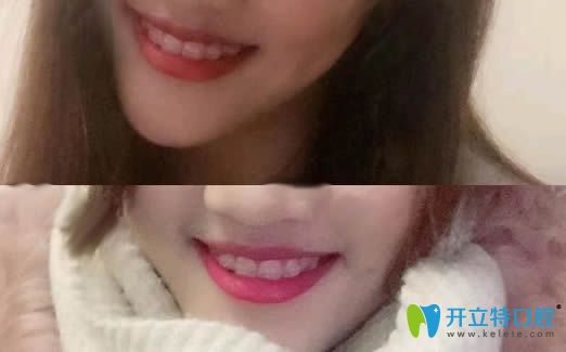 洛陽(yáng)九龍口腔牙齒正畸中戴陶瓷牙套照