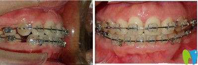 戴半隱形陶瓷牙套中的照片 戴半隱形陶瓷牙套中的照片
