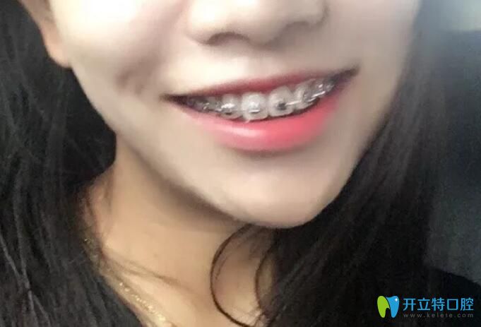 在杭州逸盛口腔做牙齒矯正半年照片