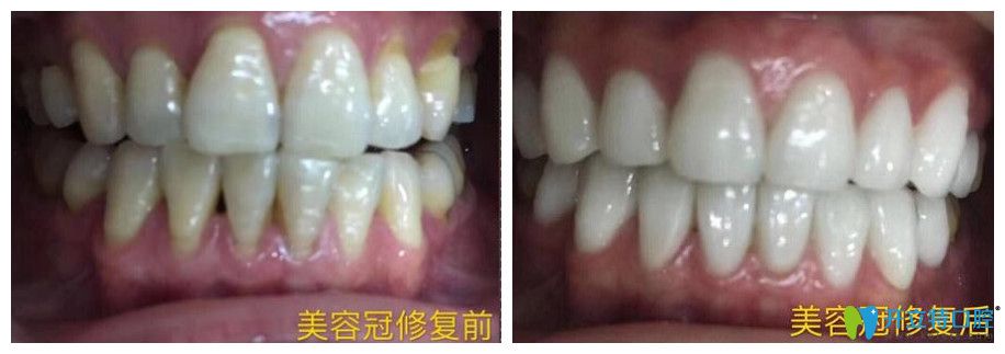 逸盛口腔真人案例驗證好不好