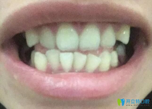 牙齒擁擠不齊選擇在杭州逸盛口腔做了正畸,歷時733天下牙套