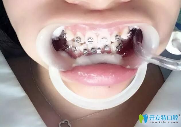 杭州逸盛口腔帶牙套第1天