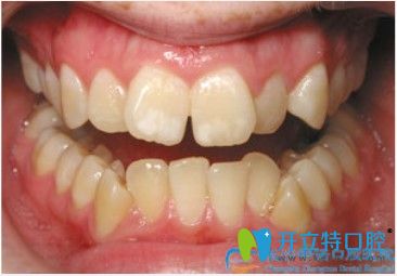 參考過長沙牙齒矯正醫(yī)院排名后去中諾口腔做了對刃頜矯正