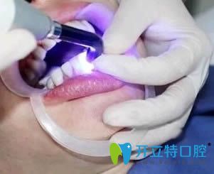 衡陽美萊口腔做全瓷牙貼面術中照