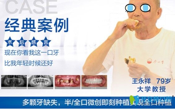 杭州美奧口腔全口種植牙案例效果