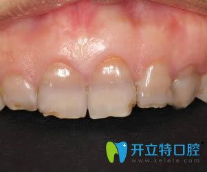 衡陽美萊口腔的超薄瓷貼面改善了我的四環(huán)素牙黃牙