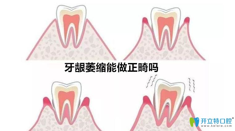牙齦萎縮能矯正牙么？聽(tīng)泗洪口腔正畸醫(yī)生解說(shuō)