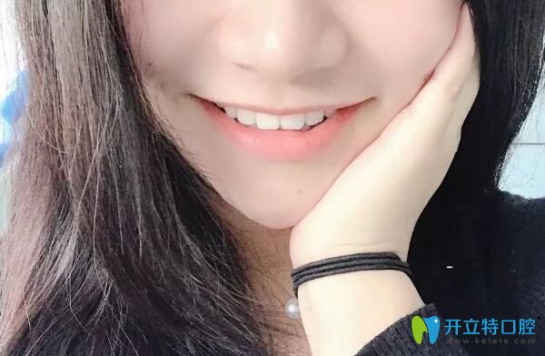 牙齒正畸733天效果圖