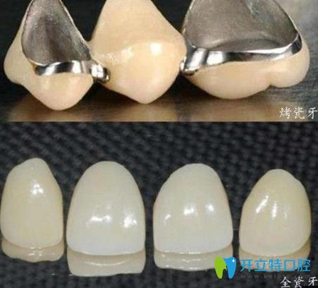 李遷醫(yī)生科普：烤瓷牙和全瓷牙的區(qū)別是什么，哪個(gè)好？