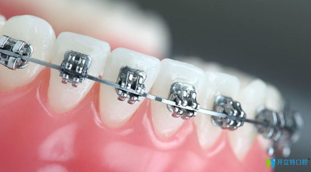 王曉涵醫(yī)生告訴大家：26歲有沒(méi)有必要矯正牙齒