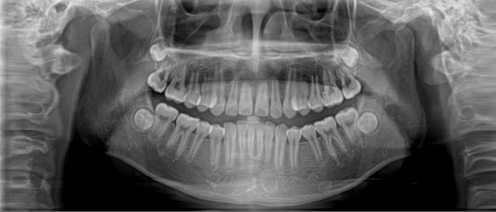 牙齒矯正前的CT/全景片檢查有必要做嗎？