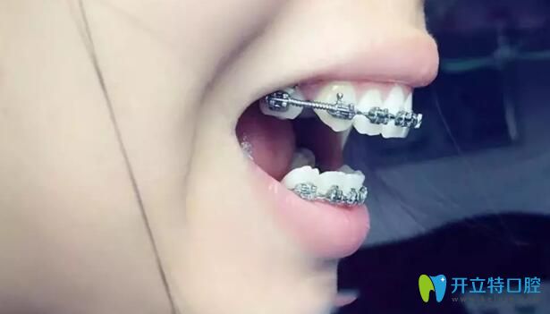 在沈陽百嘉麗口腔戴牙套樣子