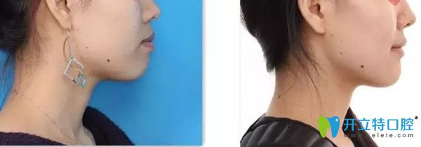 鄭州哪家正畸好?看完拜博口腔矯正案例及價(jià)格再做決定