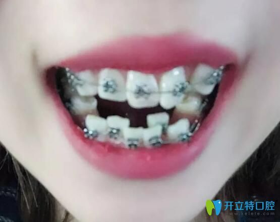 我在合肥崔勁松口腔做金屬托槽矯正13個月,牙齒擁擠沒有啦!