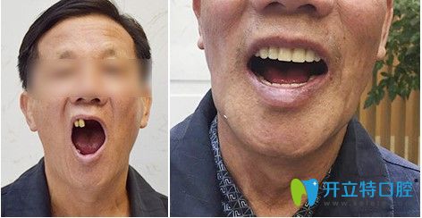 天津中諾半口種植牙