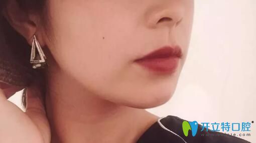 沈陽百嘉麗口腔下牙套后效果照片