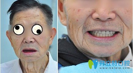 在天津中諾做過(guò)立得用全口種植牙對(duì)比效果 在天津中諾做過(guò)立得用全口種植牙對(duì)比效果