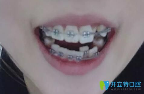 我在合肥崔勁松口腔做牙齒矯正第4個(gè)月