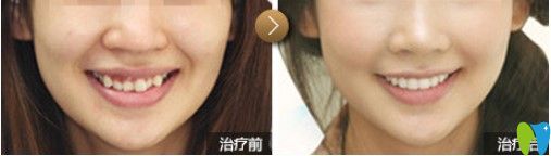 天津中諾口腔成人牙齒擁擠不齊隱適美矯正對比