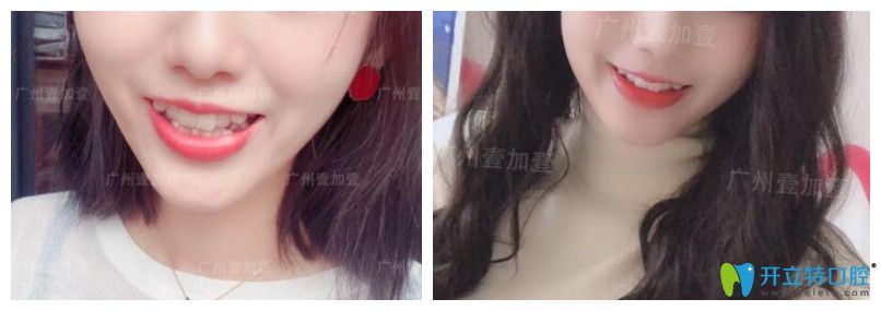 正畸和瓷貼面修復顧客用案例驗證廣州壹加壹口腔怎么樣