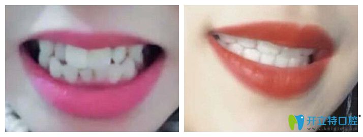 重慶牙博士口腔隱形牙齒矯正案例