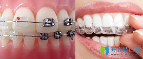 隱形矯正器和托槽矯正器示意圖