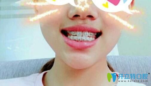 <!--<i data=20240703-sp></i>-->口腔矯正四個月牙齒變化圖