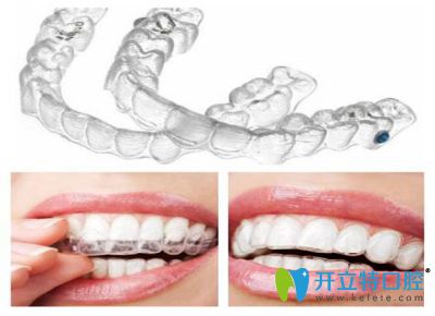 清遠(yuǎn)中大口腔醫(yī)院張廣興院長(zhǎng)分享隱形牙齒矯正優(yōu)勢(shì)