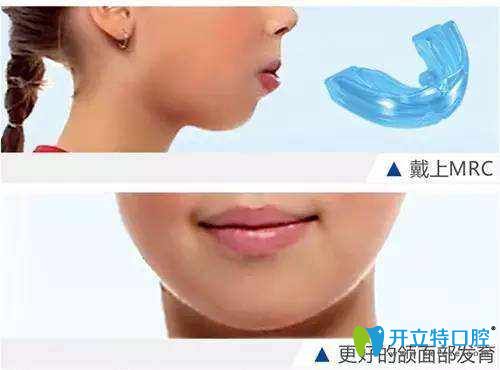清遠(yuǎn)中大口腔阮林財(cái)醫(yī)生介紹兒童牙齒畸形的原因