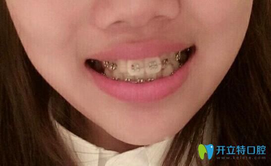 在<!--<i data=20240703-sp></i>-->口腔矯正大兔牙30天