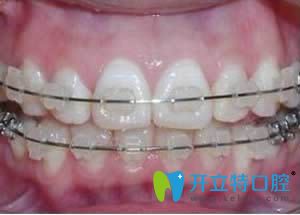 MBT直絲弓正畸圖