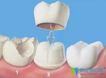 清遠(yuǎn)中大口腔黃科醫(yī)生介紹根管治療后戴不戴牙套