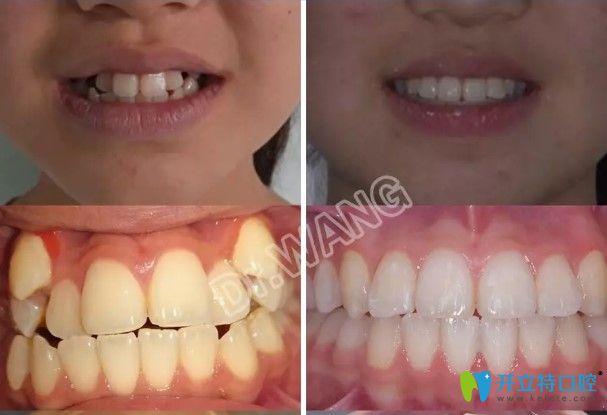 在杭州雅萊做完隱適美對(duì)刃頜矯正對(duì)比效果及臉型變化圖