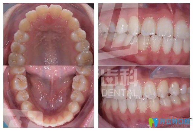 摘掉隱適美牙套后的照片
