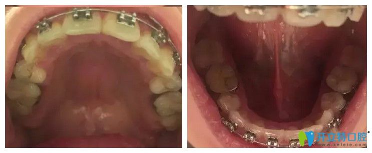 戴金屬牙套即將畢業(yè)的口內(nèi)照片