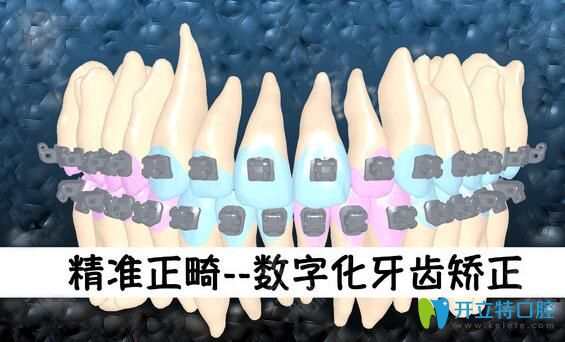 清遠(yuǎn)中大口腔阮葦醫(yī)生介紹數(shù)字化正畸技術(shù)優(yōu)勢(shì)