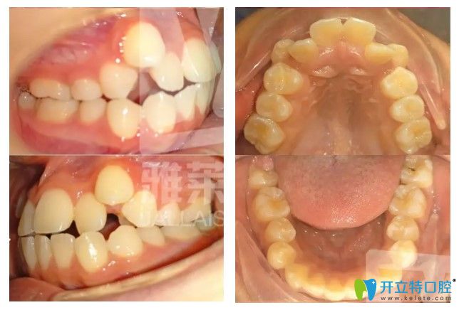 杭州雅萊口腔怎么樣?看做過隱適美對刃頜矯正的顧客如何說