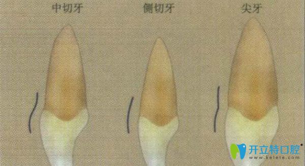 側(cè)切牙缺失可植入種植體