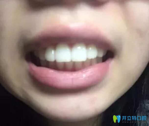 骨性+牙性齙牙在太原華美矯做了金屬鋼絲矯正，現(xiàn)下牙套了