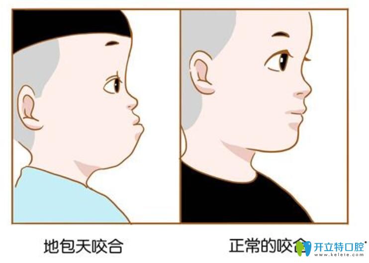 小孩地包天換牙會好嗎？太原華美口腔正畸專家解說