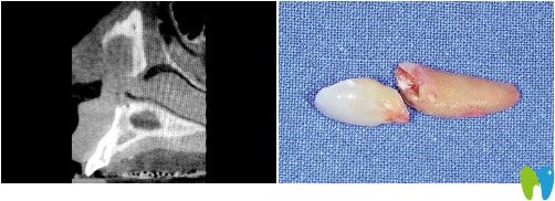 談下我做瑞士iti親水種植牙的經(jīng)歷及1年后的感受 價(jià)格心疼..