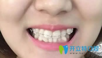 在連江縣明輝口腔做的陶瓷矯正歷經(jīng)18個月終于要下牙套了！