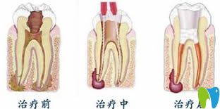 牙體牙髓病的治療步驟